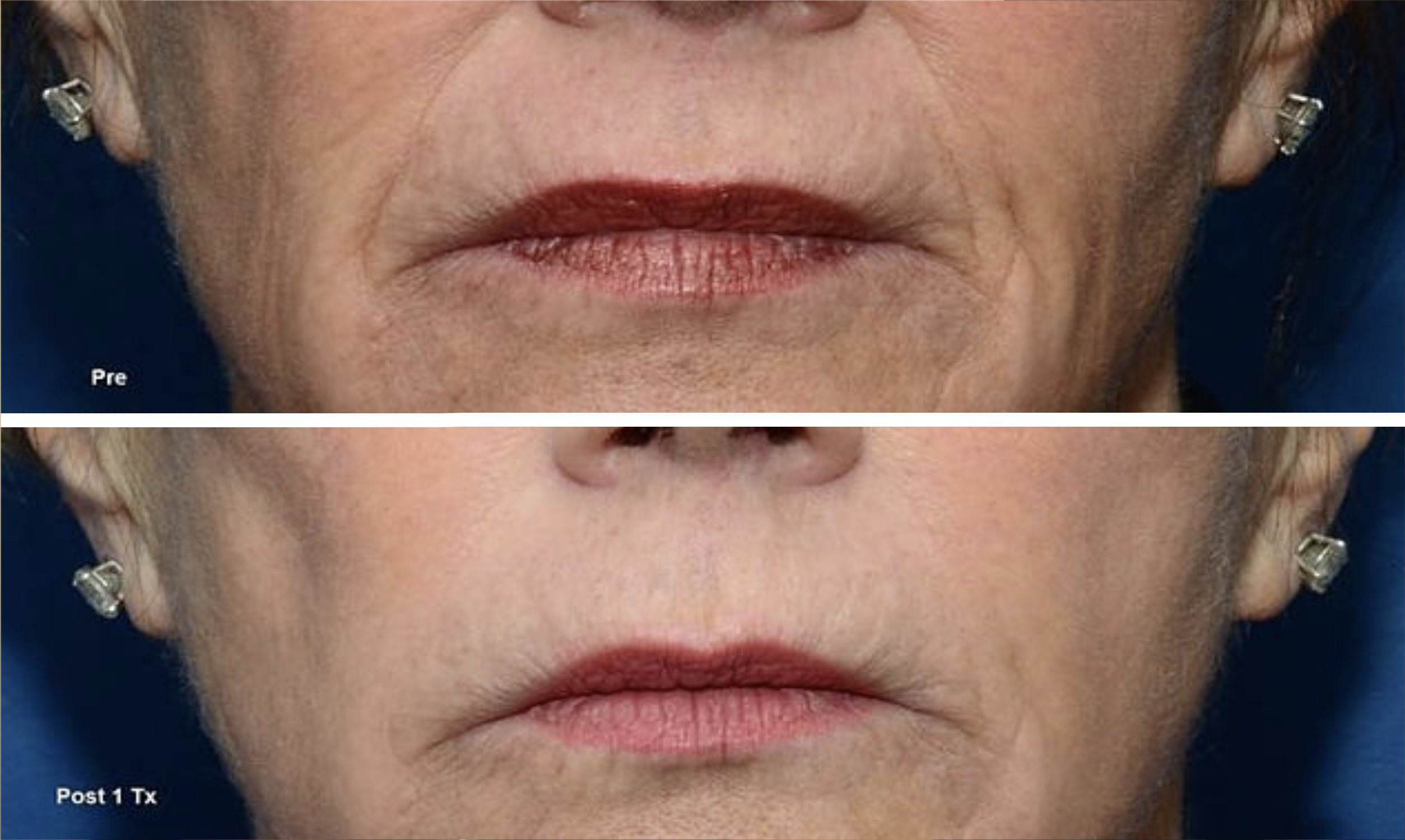 Dermal Lip Filler Treatments
